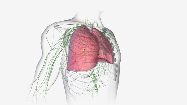Bronchiectasis is a long-term condition where the airways of the lungs become widened