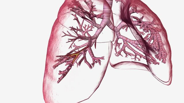 Bronchiectasis is a long-term condition where the airways of the lungs become widened