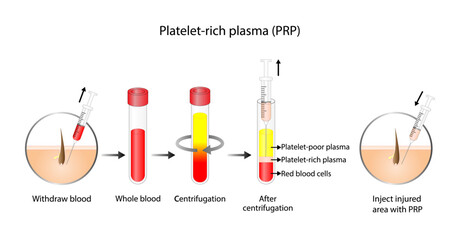 Platelet-rich plasma (prp). Autologous conditioned plasma, is a concentrate of PRP extracted from whole blood. After centrifugation, extract PRP and inject skin or hair. Vector Illustration. - obrazy, fototapety, plakaty