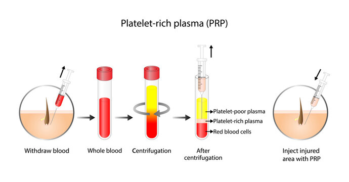Platelet-rich plasma (prp). Autologous conditioned plasma, is a concentrate of PRP extracted from whole blood. After centrifugation, extract PRP and inject skin or hair. Vector Illustration.