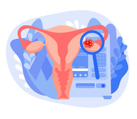 The concept of ovarian cancer. Disease of the female reproductive system. Abnormal internal organ of the uterus. Vector illustration