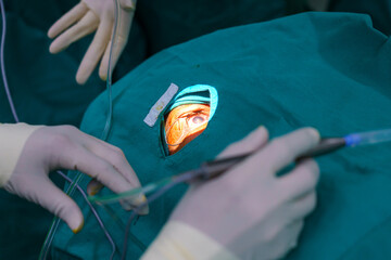 Doctor surgical operation eye lens replacement, intraocular lens installation, surgical cataract...