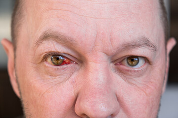 Blood in the eye of a broken blood vessels. Blood pressure. Injury. The eyeball injury from a blow. The adult man looking at the camera and rolling eyes. Impact of stress and fatigue on a human body