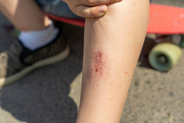 an abrasion on a child's leg from falling on an asphalt path 