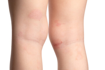 Fungal infection of the skin of the legs in a child. Defeat on the legs with a fungus, allergy close-up.