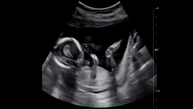 image of an ultrasound exam being performed in a prenatal