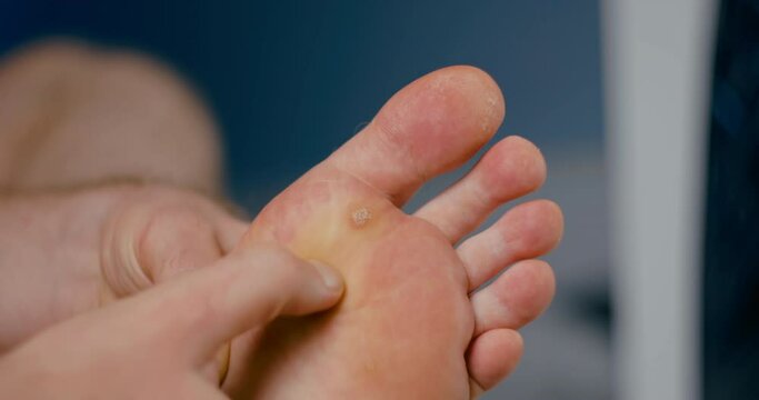 Close up shot of a warty caucasian man foot. The fingers of the hand inspect the skin near the infected area