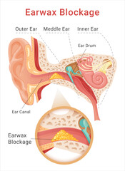 Earwax blockage medical science scheme cerumen impaction condition middle or inner ear vector flat