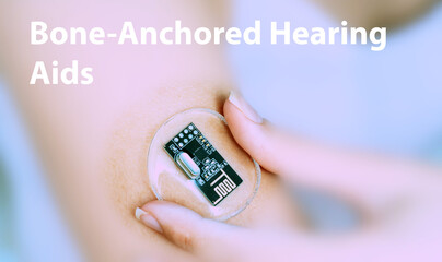 Bone-Anchored Hearing Aids Implantable Electronic Medical Devices Conc