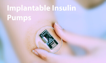 Implantable Insulin Pumps Implantable Electronic Medical Devices Conce