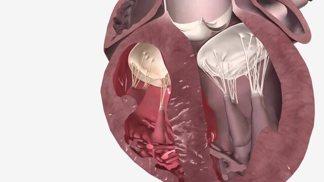 The mitral valve is located between the upper left heart chamber (left atrium) and the lower left heart chamber (left ventricle)