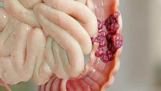 Bowel cancer or Colorectal tumor, Colon cancer, intestine inflammatory bowel Disease, intestine pain, celiac, infections, duplicating, cells expanding, malignant cancerous, viruses, 3d render