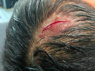 The lacerated wound as a result of impact with a sharp object