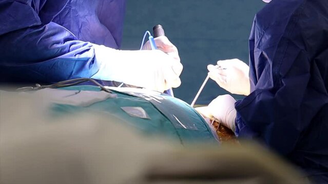 4K scene of real surgery performed by doctors on patient's body. Doctors using burning tools and other medical equipment with smoke arising concurrently stock video.