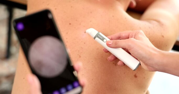 The doctor hands examine the mole on the human back, close-up. Visit to a dermatologist, dermatoscopy