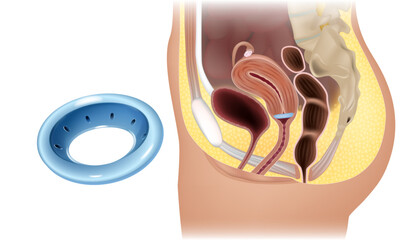 Vaginal Pessaries. Support Pessaries for pelvic organ prolapse. Gynecological and pessary