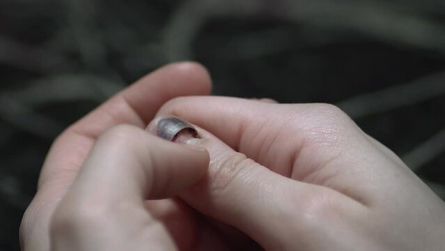 Female regrowth of a new nail after an infectious disease, injure. Subungual Hematoma on thumb nail