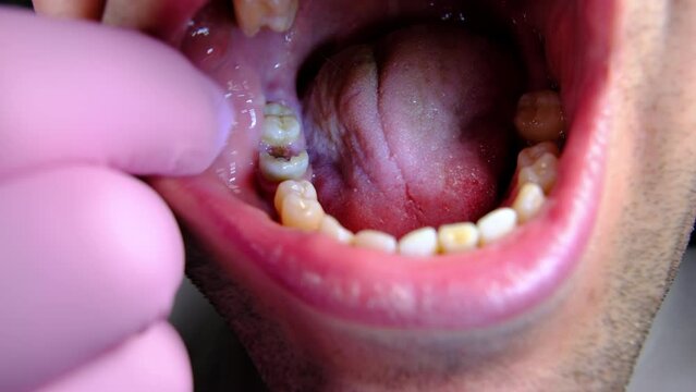 Male open mouth wide showing his rotten or bad tooth with big hole or cavity that must be extracted.