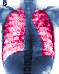 Pulmonary Tuberculosis ( film chest x-ray : interstitial infiltrate both lung )