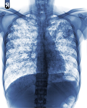 Pulmonary Tuberculosis ( film chest x-ray : interstitial infiltrate both lung )