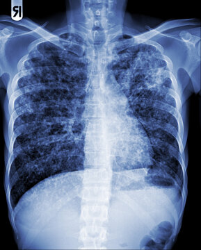 Pulmonary Tuberculosis ( film chest x-ray : interstitial infiltrate both lung )