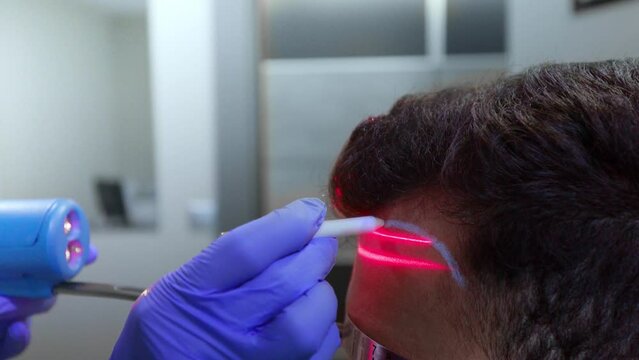 laser measures the accuracy of hair transplantation in the clinic. a device with a red laser and a white pencil in the hands of a cosmetologist. High quality 4k footage
