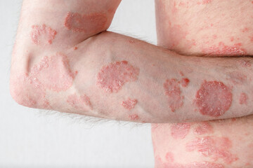Papules of chronic psoriasis vulgaris on male hand and body on neutral background.
