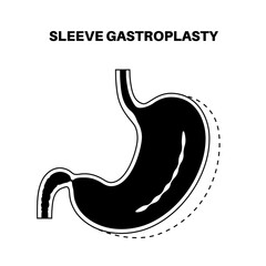 Obraz na płótnie Canvas Endoscopic sleeve gastroplasty