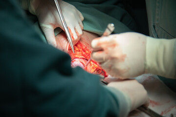 cesarean delivery procedure in hospital