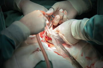 cesarean delivery procedure in hospital