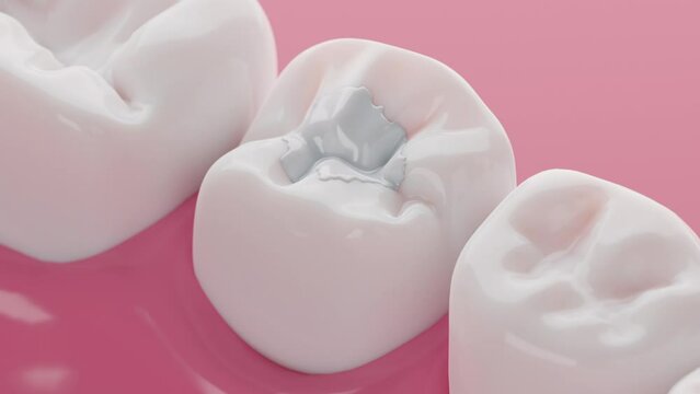 Teeth white composite filling, Decay and broken teeth treatment concept. 3D rendering.