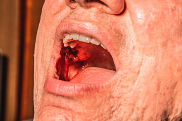 Close up man open mouth, jaw with teeth, detailed sealed bloody tooth after surgery in dental clinic. Tooth extraction treatment. Caries removing, nerve removal canals. Wisdom tooth, severe bleeding

