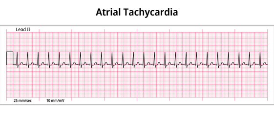 ECG Atrial Tachycardia - 8 Second ECG Paper - Electrocardiography Vector Medical Illustration

