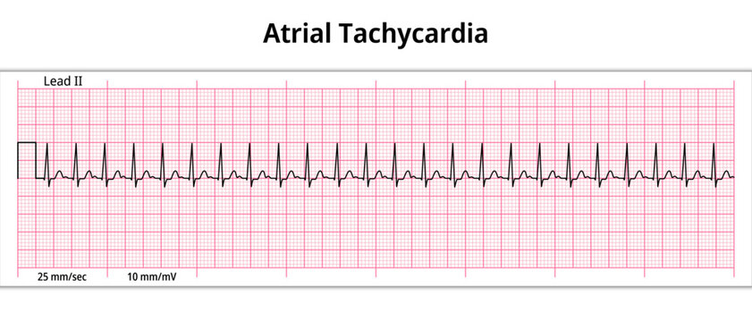 ECG Atrial Tachycardia - 8 Second ECG Paper - Electrocardiography Vector Medical Illustration

