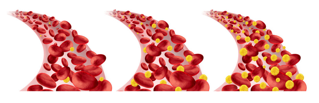 Blood Glucose as a symbol for Hypoglycemia and Hyperglycemia or Normal glucose levels as Diabetes or Diabetic symbol as low or high blood sugar resulting in insulin imbalance
