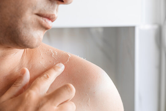 Sunburn on the skin. Exfoliation of the skin after sunburn. Man touching sun damaged peeling skin on the shoulders. The skin peels off, burnt skin