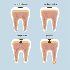 Set of teeth with stages of caries, tooth in section, tooth roots. Medicine, dental design, dental health. dental health concept. Deep, medium and initial caries, pulpitis. Dental health.