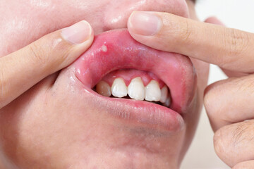 Mouth Ulcer Sore or Aphthous Stomatitis. Oral Health and Medical concepts