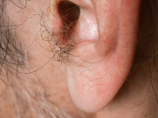 Hair growing on the earlobe and in the ear canal area in a middle-aged man