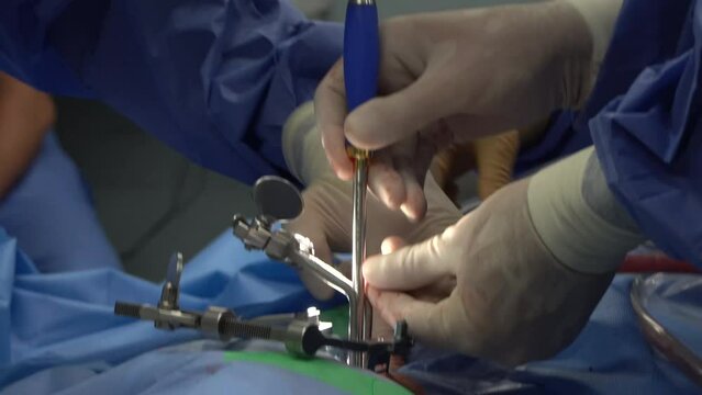 An interbody fusion cage (colloquially known as a "spine cage") is a prosthesis used in spinal fusion procedures to maintain foraminal height and decompression.