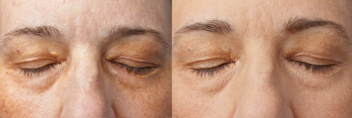 Xanthelasma on all 4 eyelids of a 55 years old woman, before and after applying camouflage make-up...