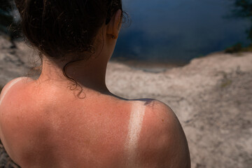  Woman shoulder with red skin burn of photosensitivity. Summer sunbathing danger.