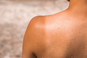  Woman shoulder with skin burn of photosensitivity. Summer sunbathing danger. Sun danger. Tanned shoulder. Copy space.
