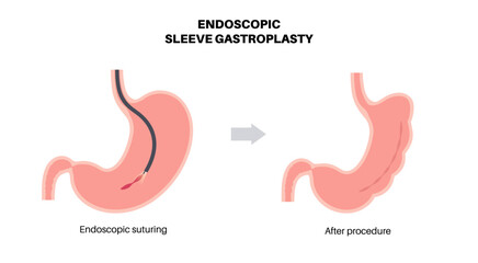 Endoscopic sleeve gastroplasty
