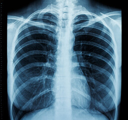 Fluorography of the human chest, frontal x-ray.