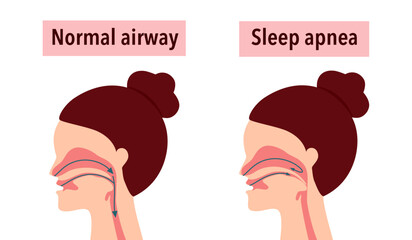 Obstructive sleep apnea syndrome concept vector illustration.