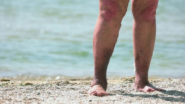 Close up ugly legs of retired old granny with varicosis. Woman with overweight.