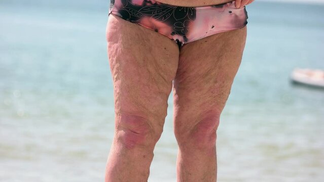 Close up ugly body of an unhealthy obesed grandmother. Cellulite and varicosis.