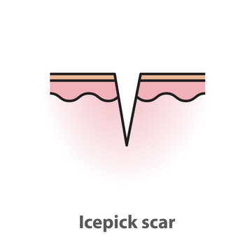  Icepick scar, atrophic scar, type of acne scar on skin surface with color and line vector isolated on white background. Skin care and beauty concept. Flat icon illustration.