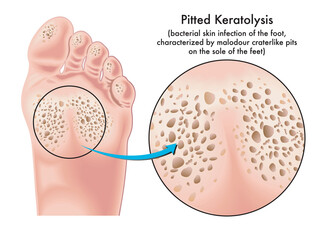 Medical illustration of symptoms of pitted keratolysis, a bacterial skin infection of the foot. - obrazy, fototapety, plakaty